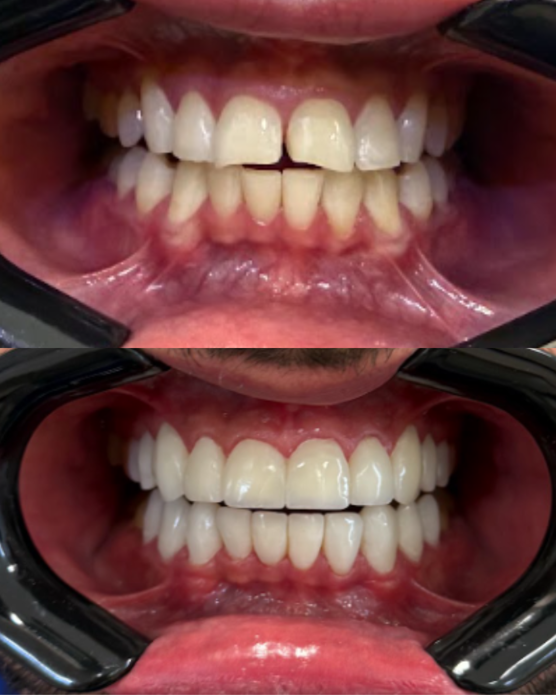 Antes e depois do tratamento com lentes em resina — caso 2