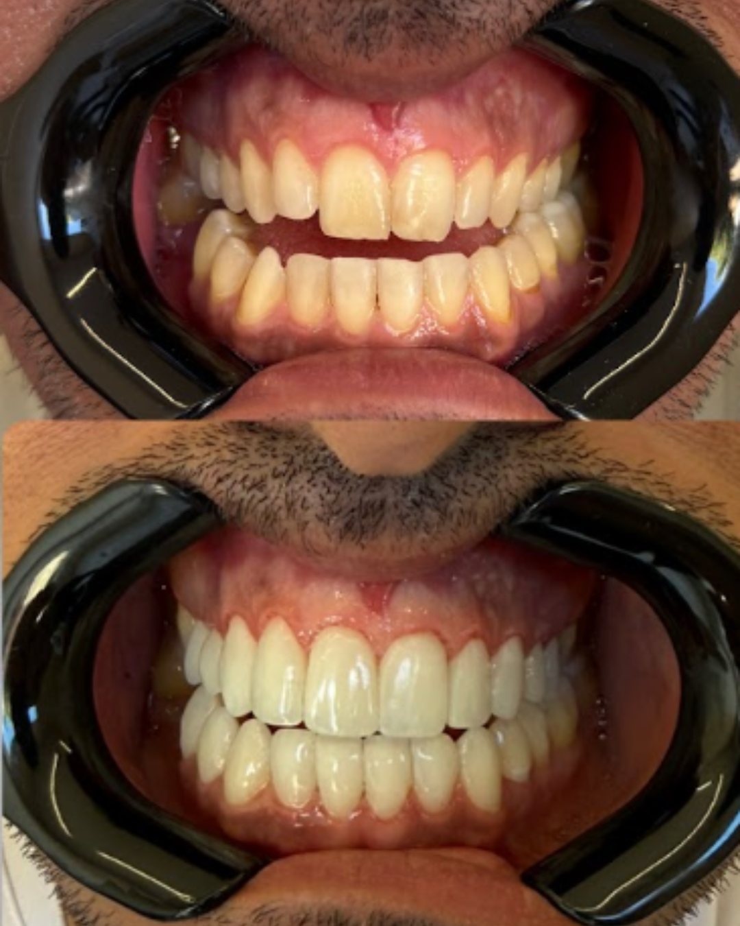 Antes e depois do tratamento com lentes em resina — caso 3