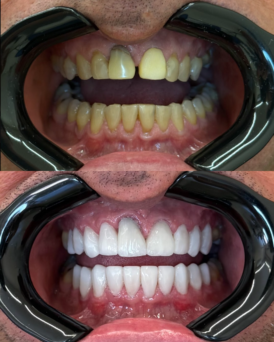 Antes e depois do tratamento com lentes em resina — caso 1